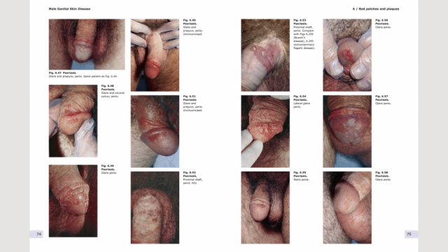 Male genital Skin Disease pages 74-75